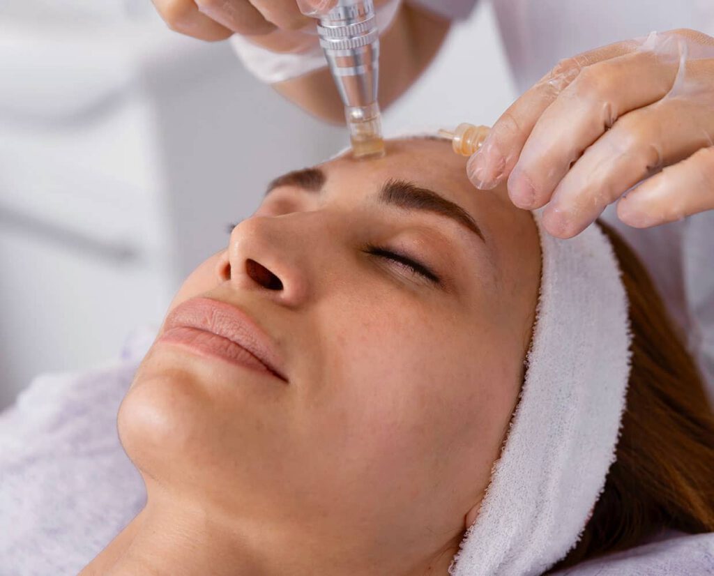 Microneedling